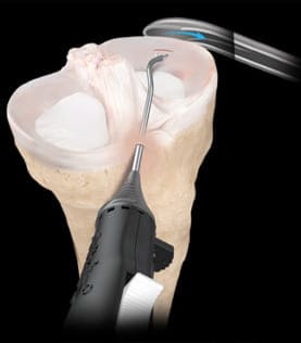 Procedimientos ortopédicos de rodilla